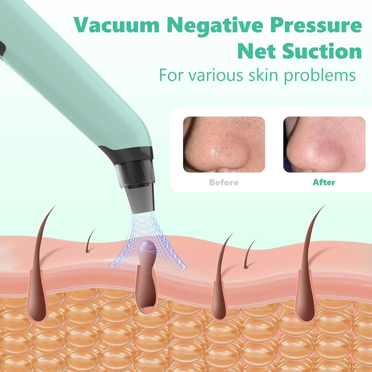 Blackhead Remover Vacuum - Black Head Remover for Face,Blackhead Extractor Tool with 3 Adjustable Suction Levels,4 Probes,USB Interface Type Pore Vacuum,Suitable for Women and Men (Green)