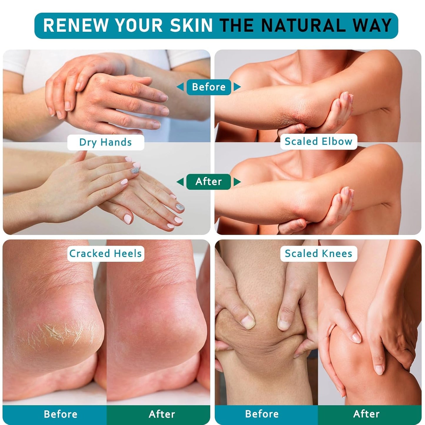 Urea Cream 40 Percent For Feet Maximum Strength - plus Salicylic Acid 2% Foot Cream For Dry Cracked Heels Feet Knees - Dead Skin Cuticle Callus Remover Toenail Softener - Pack of 2