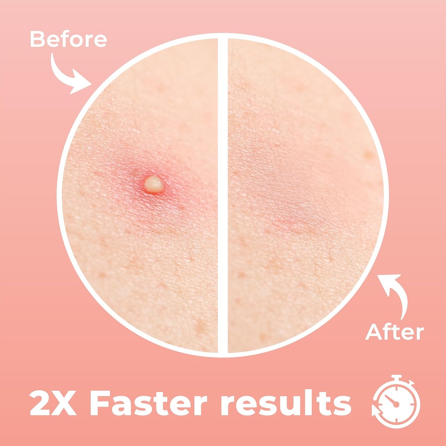 Micro Needle Pimple Patch (18 Pack) - Hydrocolloid Micropoint Pimple Patch For Acne & Pimples, Eliminate Pimples Overnight, Microdart Patch, Micro Dart Pimple Patches