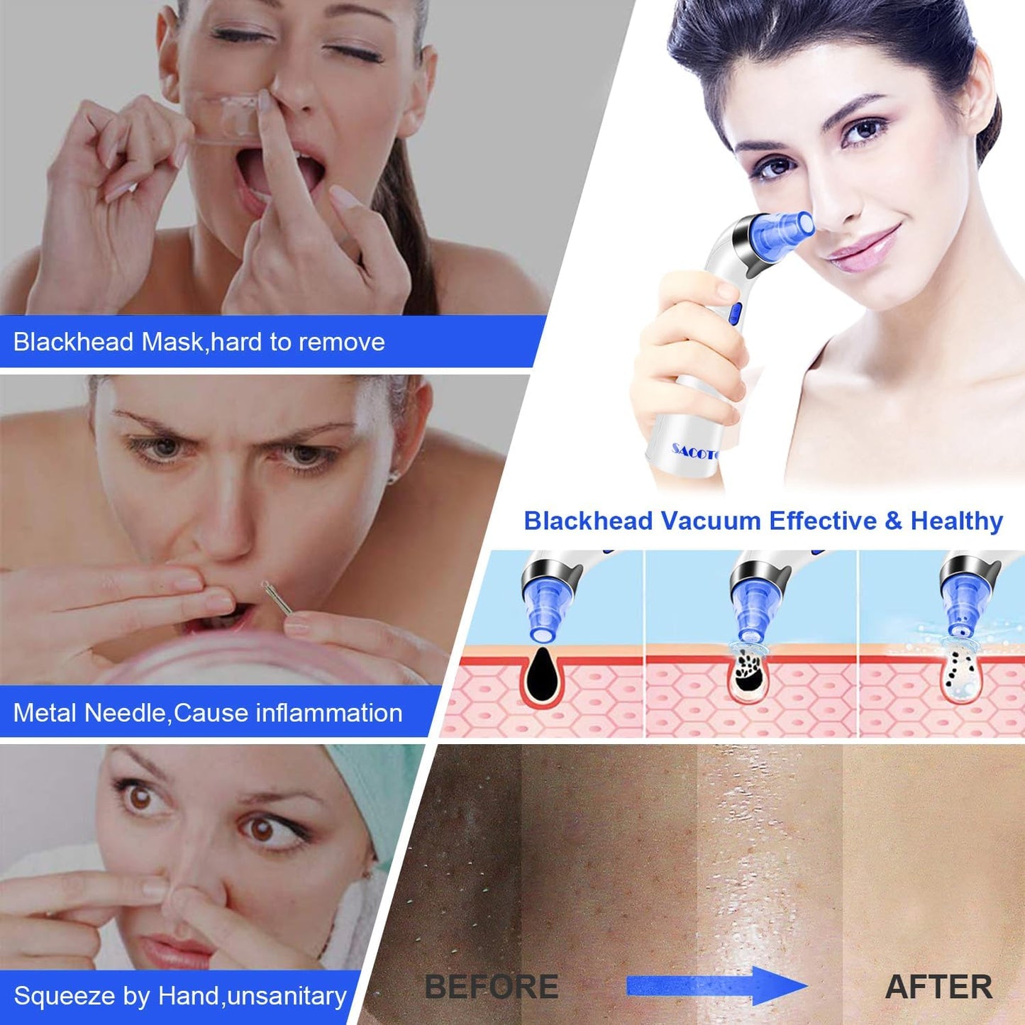 Blackhead Remover Pore Vacuum, Face Suction Pore Cleaner, 5 Suction Power Electric Blackhead Extractor Tool, 4 Probes, Blackhead Suction Remover for Women & Men（Blue）