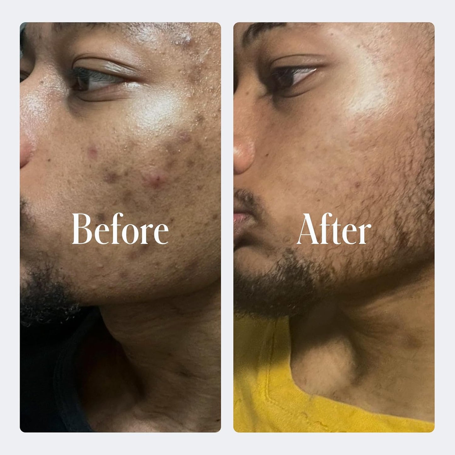 Geologie Clear System | 3-Step Acne Treatment & Skincare Set | Clears Skin Fast | Acne Gel Cleanser, SPF15 Day Cream & .2% Retinol Face Cream For Men & Women | Month 2 / Level 2