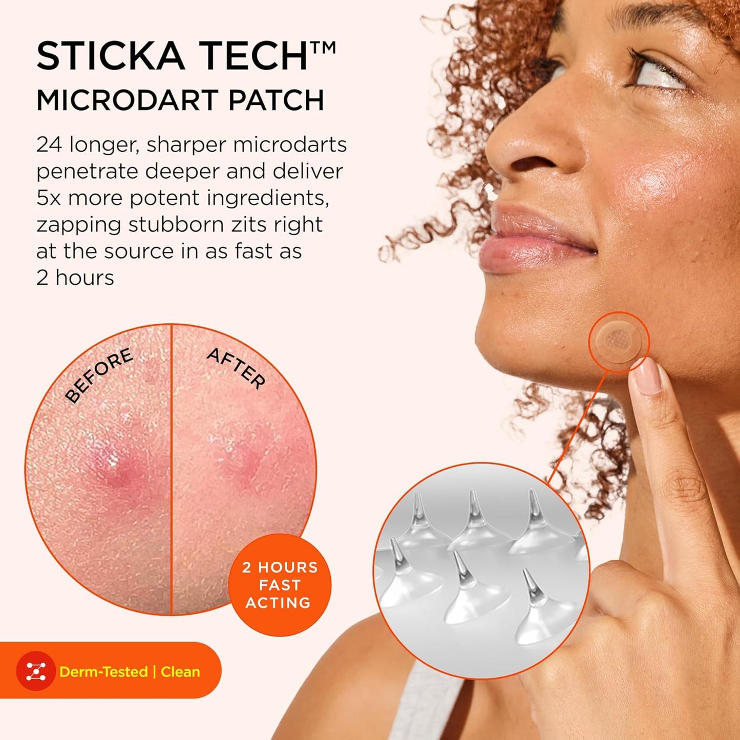 ZitSticka Extra Strength Killa Acne Patches for Face - World's Most Potent Pimple Patch with Fast-Acting Microdarts - Starts Working within 2 Hours for Deep, Early-Stage Zits & Blemish - 4 Count