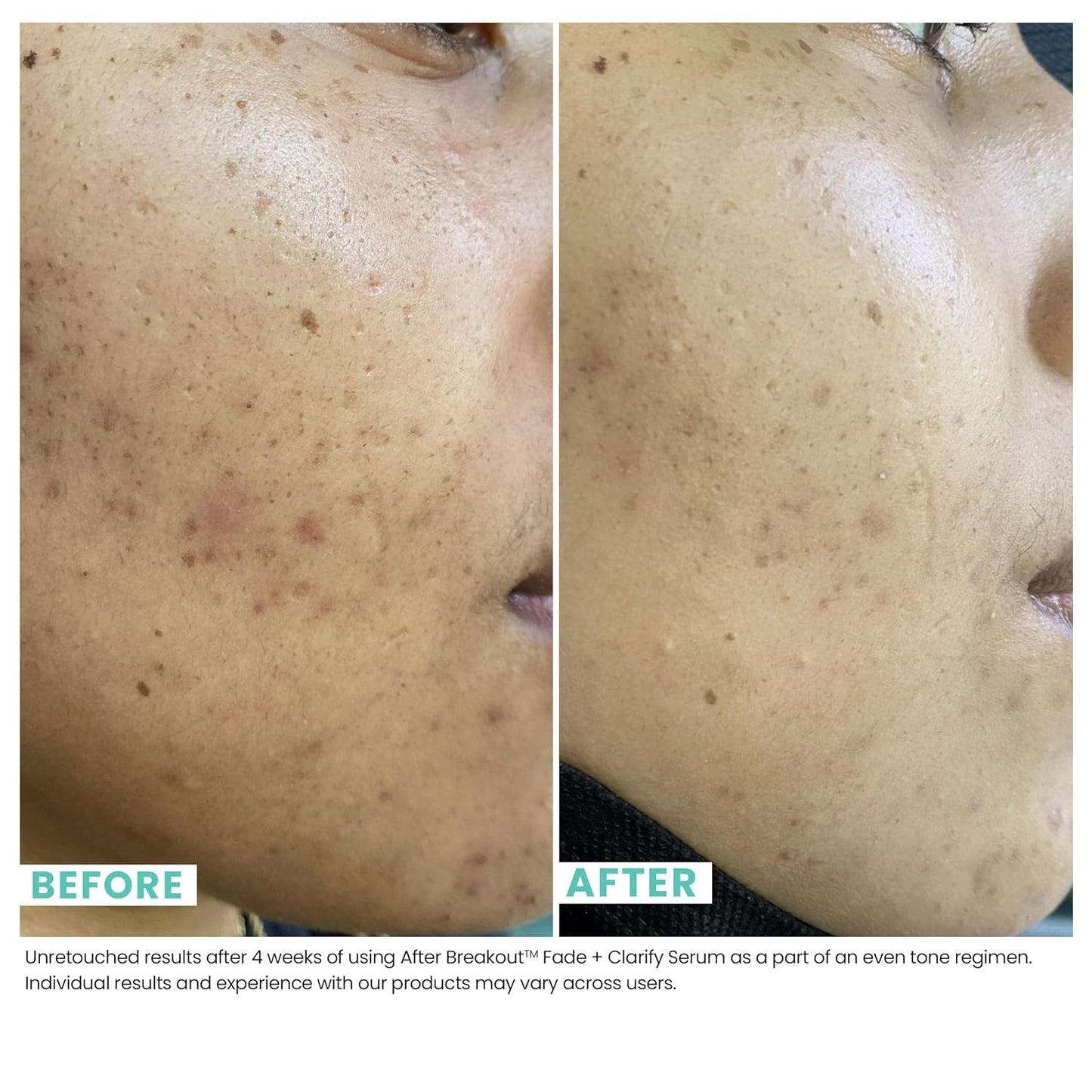 Urban Skin Rx, Acne & Dark Spot Essentials Starter Kit, Includes Clear Skin Cleansing Bar, Acne Serum + Spot Treatment & Fade + Clarify Serum, Cleanses Pores, Fades & Fights Breakouts