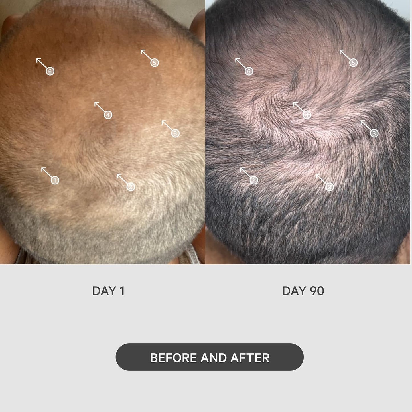 DS Labs StimuROLLER Hair Micro-Needle Hair Stimulation System 0.25mm, Packaging May Vary