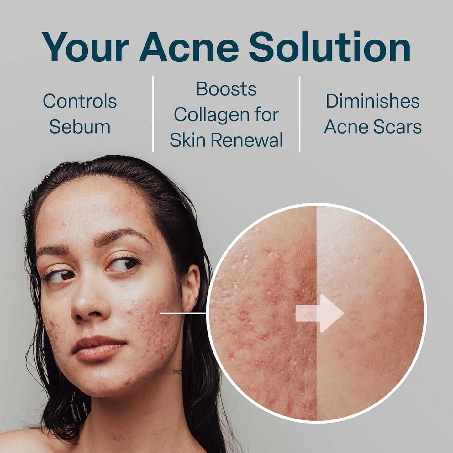 QRxLabs Salicylic & Glycolic Acid Acne Control Pads - 50 Count Jar - Glycolic & Salicylic - Bacne Treatment with Vitamins B5, C & E, Calendula & Green Tea